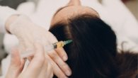 Preços da Mesoterapia Capilar e Como Funciona
