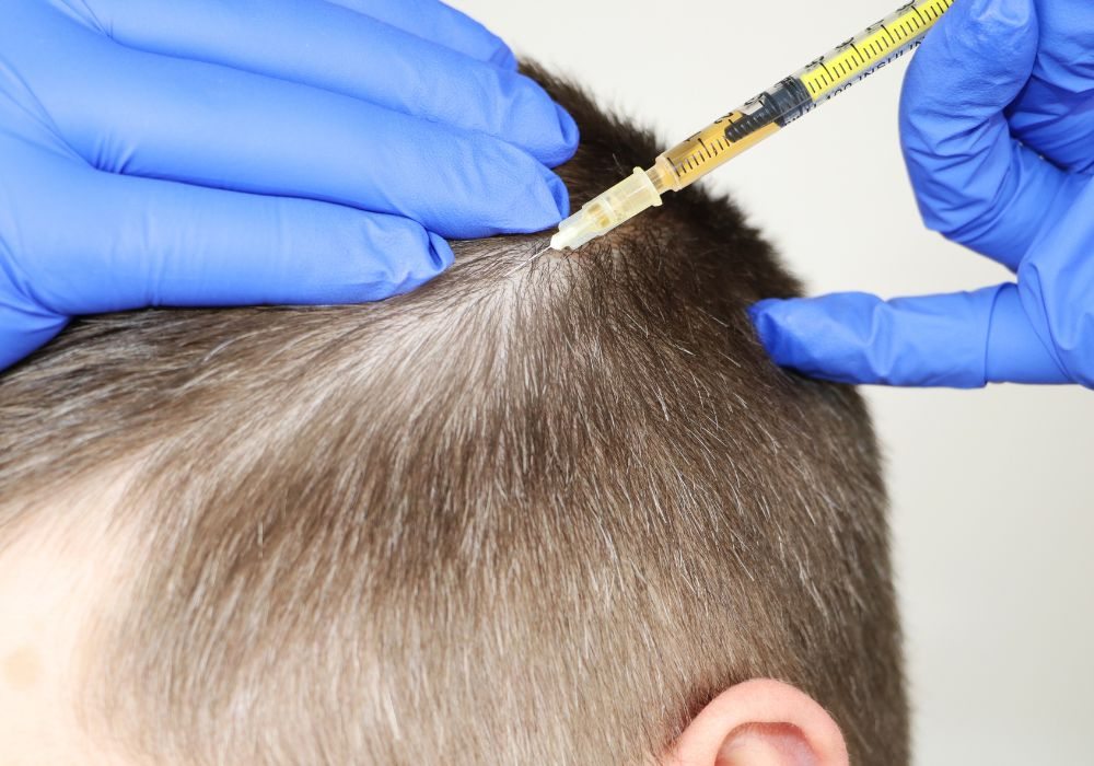 Quanto Custa a Mesoterapia Capilar