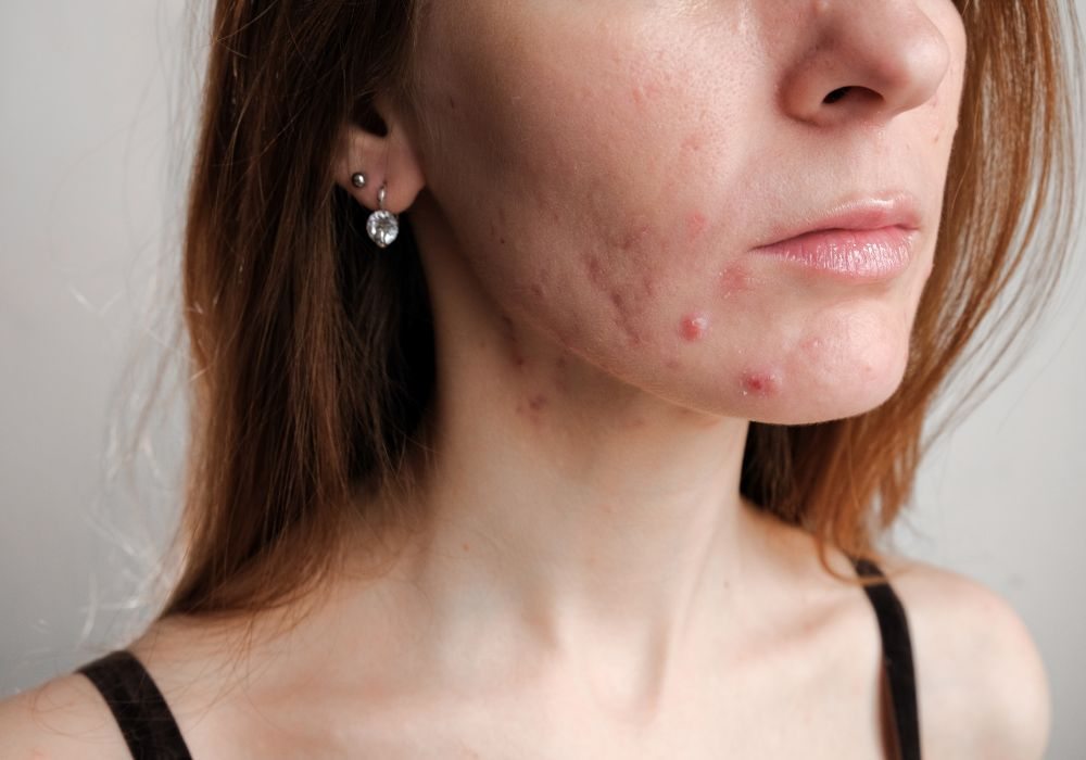 Como Tratar a Acne