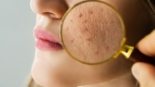 O que é Acne, Como Aparece e Como Tratar + Dicas de Produtos