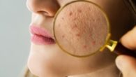 O que é Acne, Como Aparece e Como Tratar + Dicas de Produtos