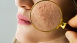 O que é Acne, Como Aparece e Como Tratar + Dicas de Produtos