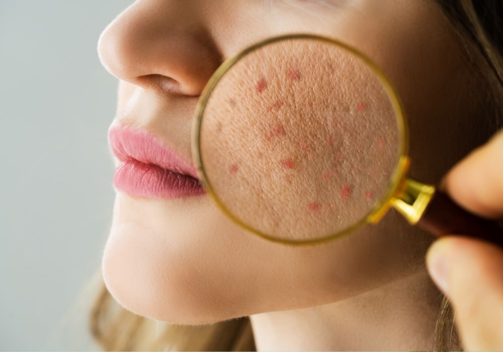 O que é Acne, Como Aparece e Como Tratar + Dicas de Produtos