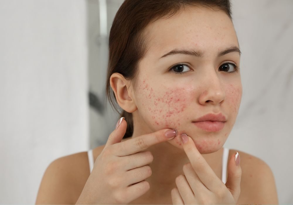 Quais os Melhores Produtos para Tratar Acne e Quanto Custa em Média