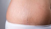 Melhor Tratamento para Estrias Brancas e Vermelhas e Quanto Custa em Média
