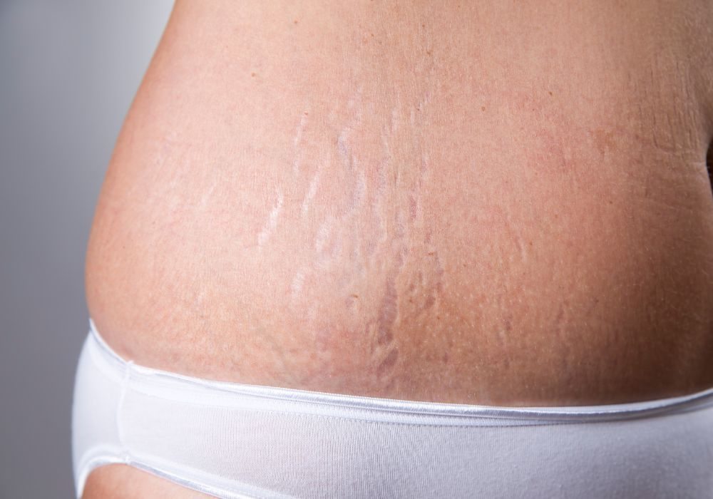 Melhor Tratamento para Estrias Brancas e Vermelhas e Quanto Custa em Média